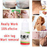 Body Warts Corn Mole Genital Wart Treatment