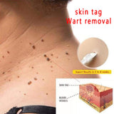 Body Warts Corn Mole Genital Wart Treatment